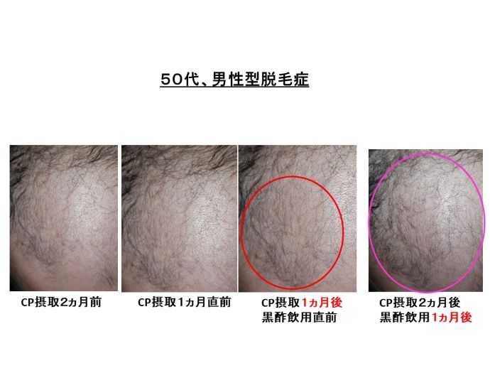 円形脱毛症　病院